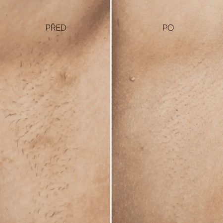 Eggo profesionálne IPL zariadenie na odstránenie chĺpkov Lumer Pro IPL